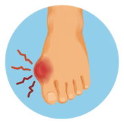 Bunion Pain