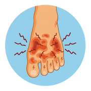 Neuropathy
